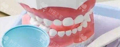 全口活动假牙展示