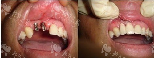 种牙前后照片