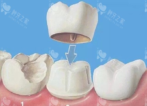 种牙后做牙冠一般选什么样的材料好？从价格、耐用度、美观度对比，帮你选性价比高的