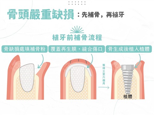 历德LM种植体建议用吗？95%临床留存率+可验真防假，没进集采也值得选！