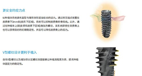 韩国沃兰种植牙优势图片