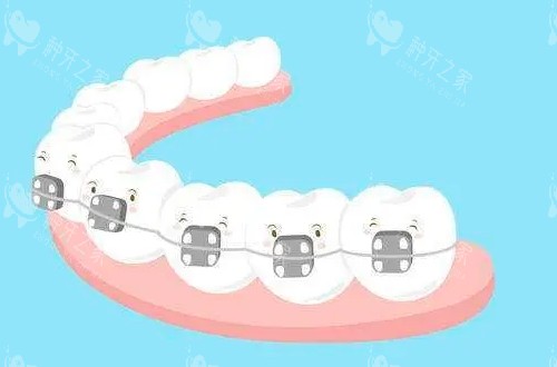 传统牙齿矫正器动画展示图
