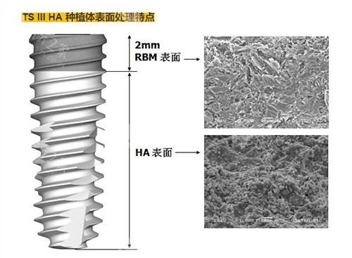 奥齿泰TS3植体材质优势 奥齿泰TS3植体材质优势