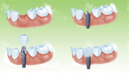 韩国八维种植体质量怎么样?优势突出缺点少
