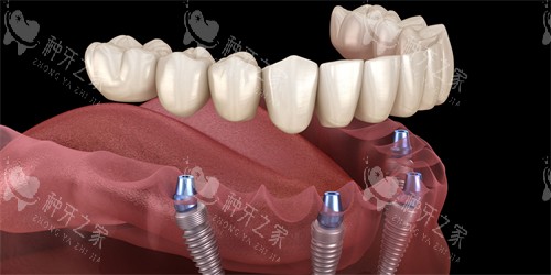 HTDIC种植体好不好用?咀嚼稳如天然牙超好用!