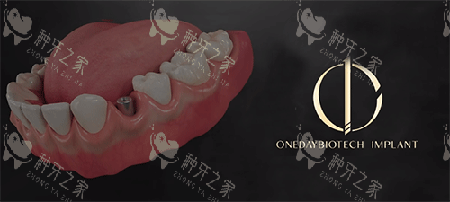 美国3i种植体能用多久？养护好能长期用！