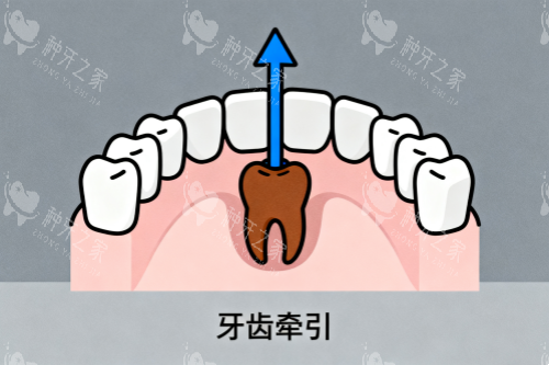牙齿牵引卡通图 牙齿牵引卡通图