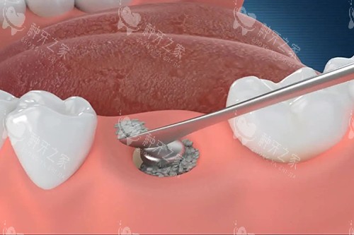 奥齿泰与登腾怎么选?骨量差选奥齿泰SA亲水型!