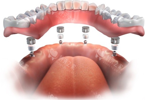 半口种植牙牙冠安装示意图 半口种植牙牙冠安装示意图