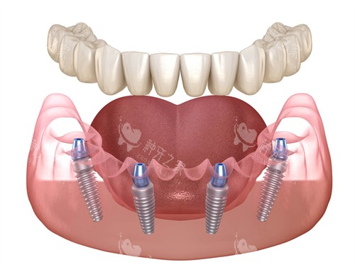 半口种植牙动画图示 半口种植牙动画图示