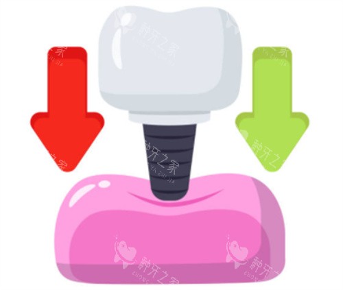 种植牙的用力示意图 种植牙的用力示意图