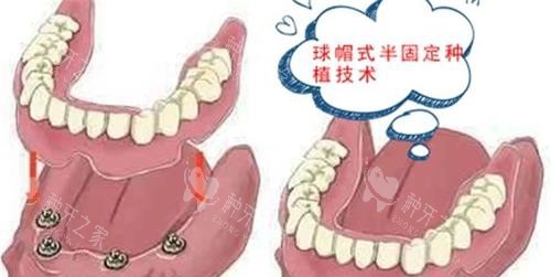 漫画半口种植牙示意图 漫画半口种植牙示意图