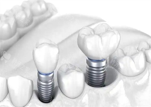 种植牙图片展示 种植牙图片展示