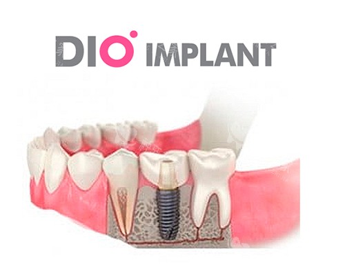 韩国DIO种植体好吗?材质|价格|使用年限等公布
