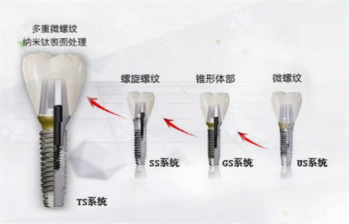 韩国奥齿泰种植体型号 韩国奥齿泰种植体型号