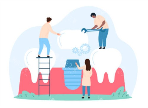 瑞西欧种植体建议用吗？缺牙修复选它超靠谱！