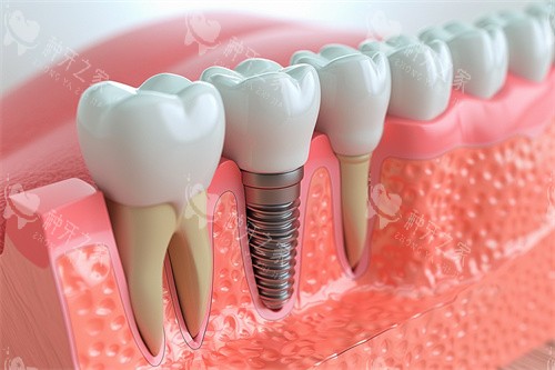 种植牙与正常牙齿模型对比漫画图