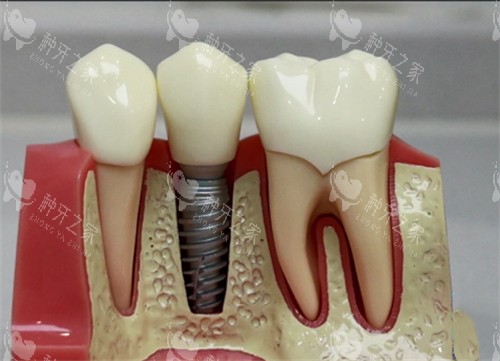 25年哈尔滨种植牙价格一览!1200+含国产/进口