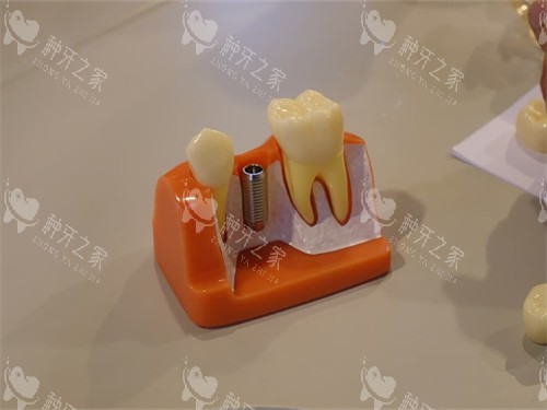 种植牙植体和牙齿模型图 种植牙植体和牙齿模型图