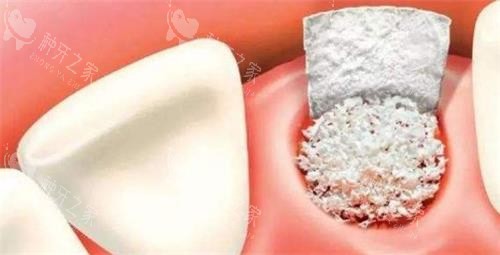 牙科骨粉示意图 牙科骨粉示意图