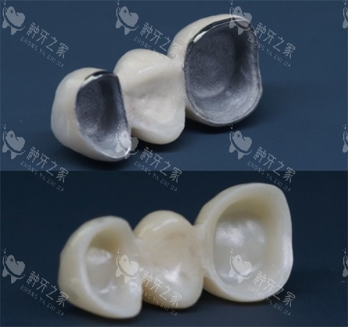 烤瓷牙和全瓷牙 烤瓷牙和全瓷牙