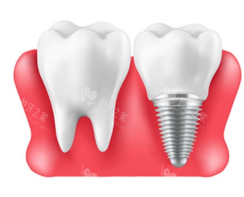 广州种植牙费用？全口3万起+多品牌可选