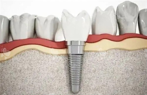 种植牙动画图片 种植牙动画图片