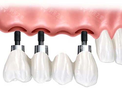 种植牙固定桥修复体 种植牙固定桥修复体