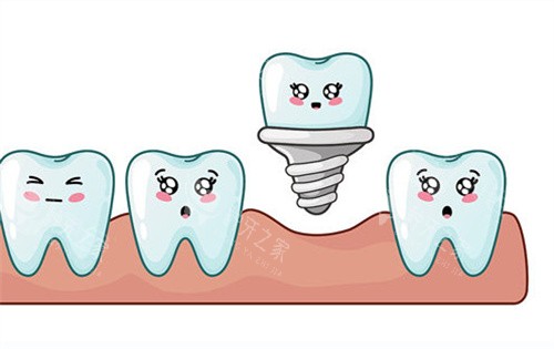 种植牙动画展示图片