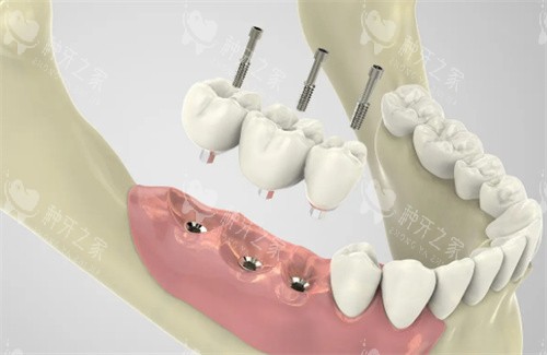 种植牙过程展示图片 种植牙过程展示图片