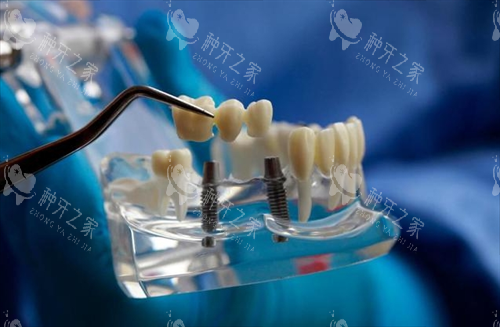 以色列雅定和韩国奥齿泰种植体哪个好?价格/寿命对比