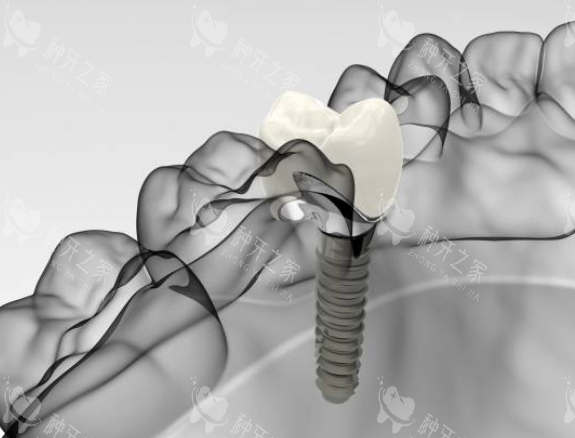 种植牙模拟图 种植牙模拟图