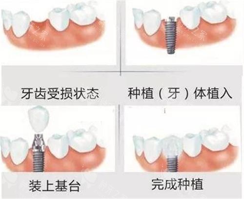 乌海种植牙哪家医院好?高口碑机构的种植体品牌任选