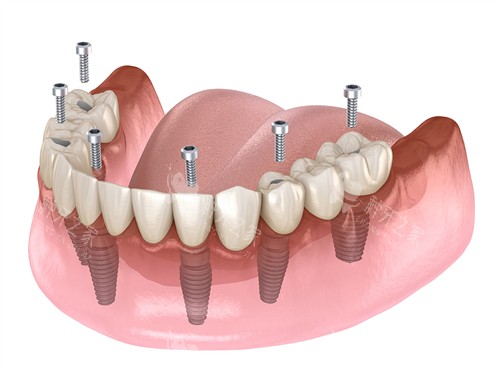 深圳拜尔口腔种植牙怎么样?解析种牙技术与价格~ 深圳拜尔口腔种植牙怎么样?解析种牙技术与价格~