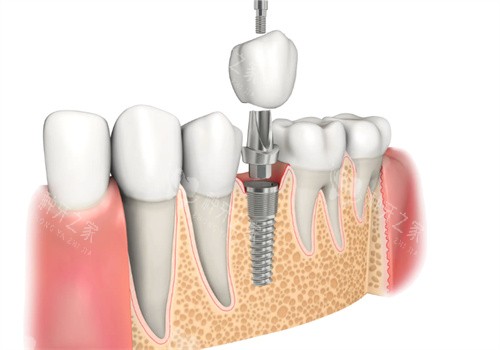 曲靖种植牙多少钱一颗？单颗2800元起！