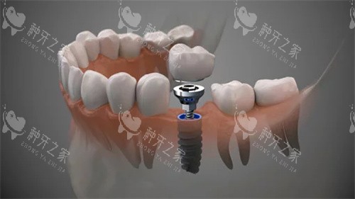 种植牙和牙桥哪个更合适?不同口腔情况对应不同答案