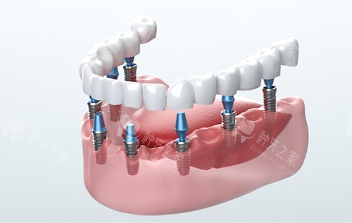 贵阳云岩区哪家种植牙好?柏德口腔优势多 贵阳云岩区哪家种植牙好?柏德口腔优势多