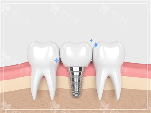 种植牙与真实牙齿漫画示意图 种植牙与真实牙齿漫画示意图