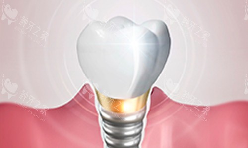 种植牙动画图 种植牙动画图