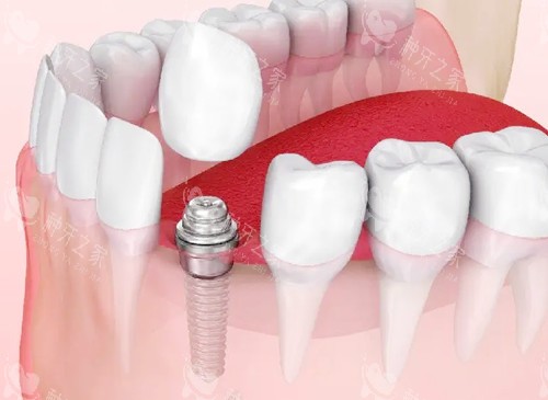 亲测!长沙牙祖口腔种牙体验超棒