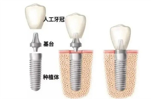 石家庄种植牙好的大约多少钱？全品牌价格参考