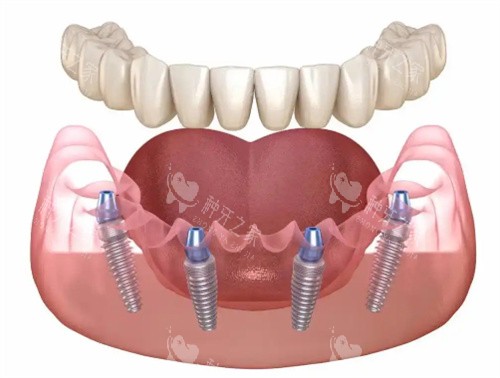 种植牙展示卡通图 种植牙展示卡通图