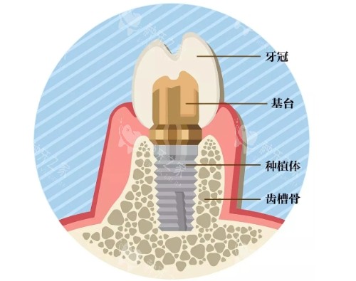 博德口腔种牙贵吗？真实报价+技术优势+市民评价