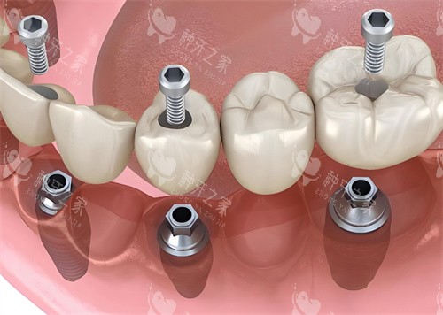 呼市2025种牙多少钱？1980+/附不同品牌价格