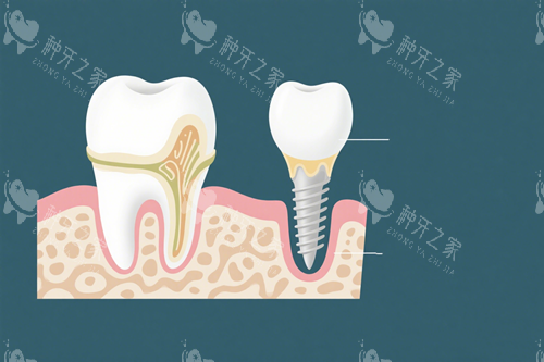 种植牙示意图 (1) 种植牙示意图 (1)