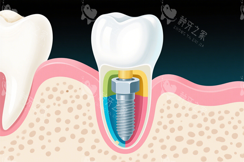 肇庆种牙3000元起！2025价格抢先看