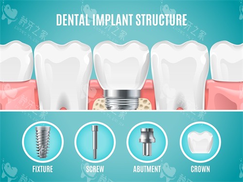 种植牙植体组成部分展示 种植牙植体组成部分展示