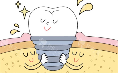 种植牙卡通展示图片 种植牙卡通展示图片