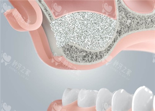 植骨种植牙 植骨种植牙