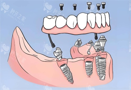 全口种植牙卡通图片 全口种植牙卡通图片
